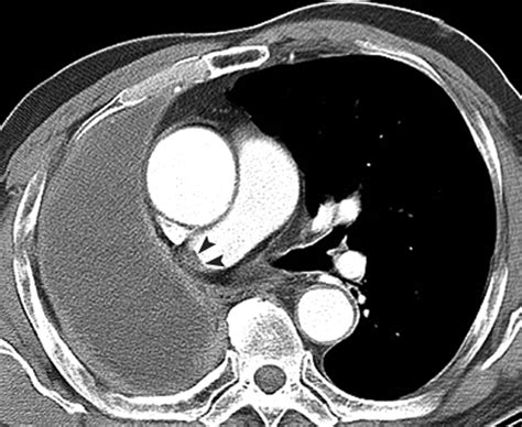 Filling Defect In A Pulmonary Arterial Stump On CT After Pneumonectomy