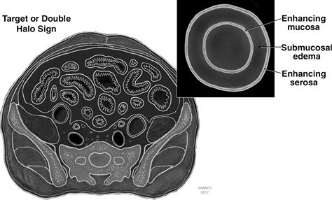 Ct Findings Of Acute Small Bowel Entities Radiographics