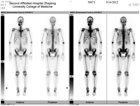 Multifocal Langerhans Cell Histiocytosis In An Adult With A