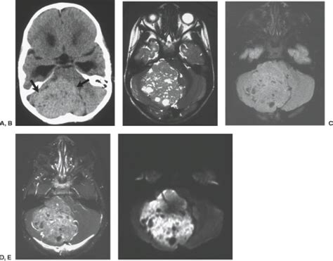 Pediatric Brain Tumors Radiology Key