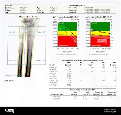 Normal Bone Density Scan