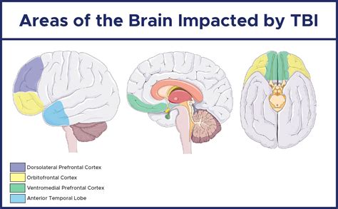 Neuropsychological Evaluation Of Traumatic Brain Injury The Definitive