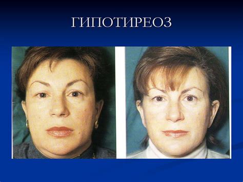 Заболевания щитовидной железы и беременность - презентация онлайн