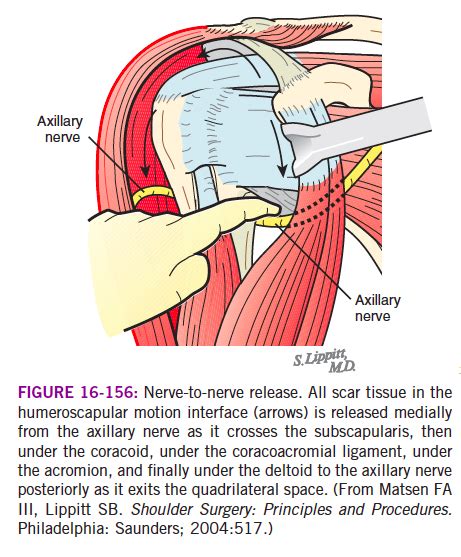 UW Shoulder and Elbow Academy: The safe side and the suicide of the ...