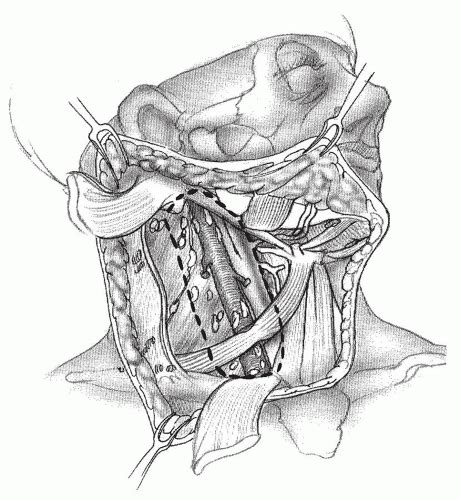 Neck Dissection Diagram