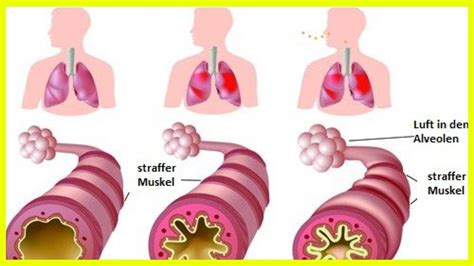 Chronisches Asthma Und Allergien Was Kann Ich Tun YouTube