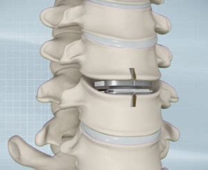 Cervical Disc Replacement | Advanced Orthopaedics & Sports Medicine, Orthopaedic Specialists ...