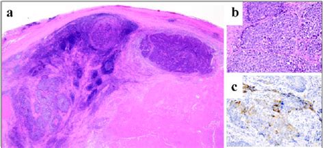 Histological Findings For The Lymph Node Showed Central Necrosis A He