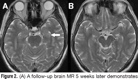 Figure 2 from Bilateral hippocampal abnormalities on diffusion-weighted ...