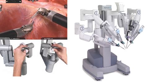 Healthy ViewpointsRobotically Assisted Laparoscopic Hernia Repair