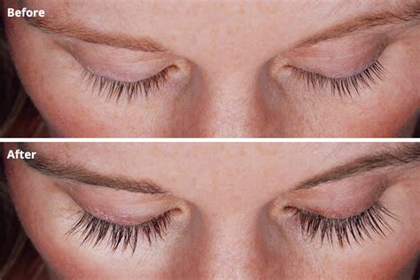 Are Your Lashes Thinning 5 Things You Need To Know About Latisse