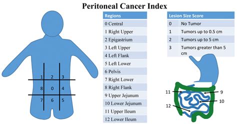 Peritoneal Cancer Index Pci Scoring System Pci Is A Diagnostic And