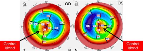 Collaborative Case 011 Treating Irregular Astigmatism After Laser