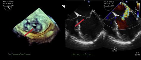 Percutaneous Repair Of Mitral Valve Leaflet Perforation Jacc