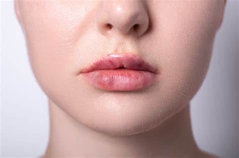 Lip Filler Migration How To Fix And Prevent IIAM