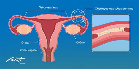 O Que Obstru O Das Tubas Uterinas Art Medicina Reprodutiva