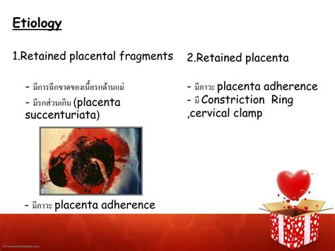 Retained Placental Fragments