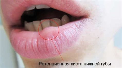 Herpes on the inside of the lip: photo, treatment