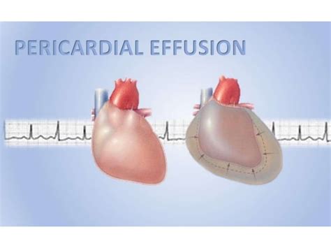 Pericardial Effusion Cardiac Tamponade And Myocardial Rupture Ppt