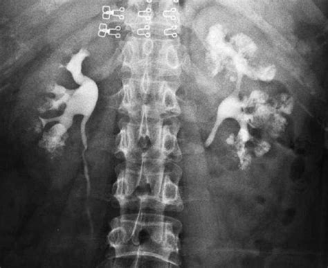 病例304 海绵肾 临床影像诊断 医学