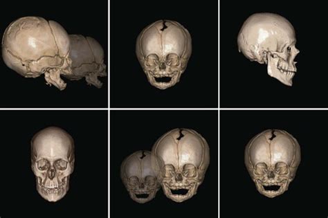 14 Facial Growth And Development Pocket Dentistry