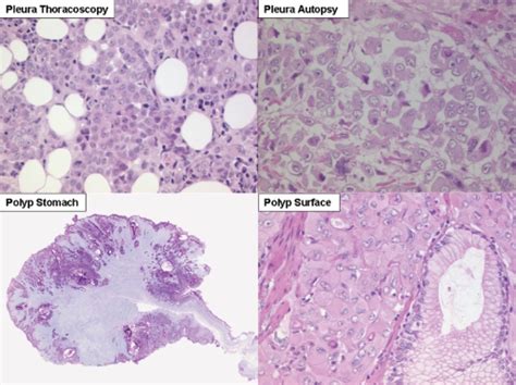 Epithelioid Mesothelioma At Diagnosis In Pleura At Autopsy In Pleura