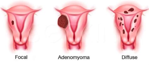 Adenomyosis Symptoms Causes And Treatment Ultrasoundfeminsider