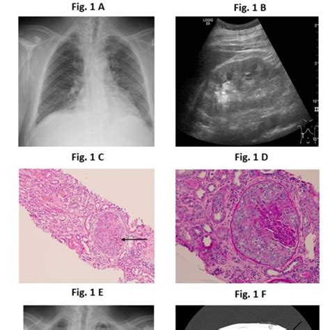 A X Ray Of The Chest Ground Glass Opacities In The Medial And Lower Download Scientific