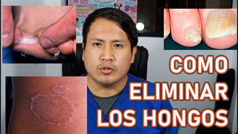 COMO ELIMINAR LOS HONGOS DR APARI YouTube