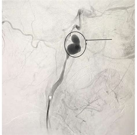 Preoperative Angiography Of The Left ICA Showing The Pseudoaneurysm