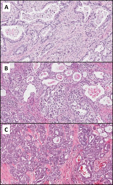 International Endocervical Adenocarcinoma Criteria And Classification