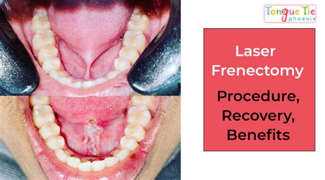 Laser Frenectomy: Procedure, Recovery, Benefits And All About It