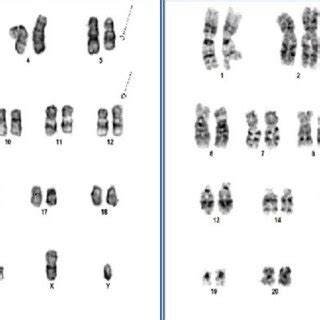 Karyotype Of The Patient S G Banded Bone Marrow Metaphase Cells Shows