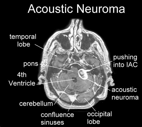 Neuroma, Acoustic; Acoustic Neuroma; Schwannoma, Acoustic; Schwannoma ...