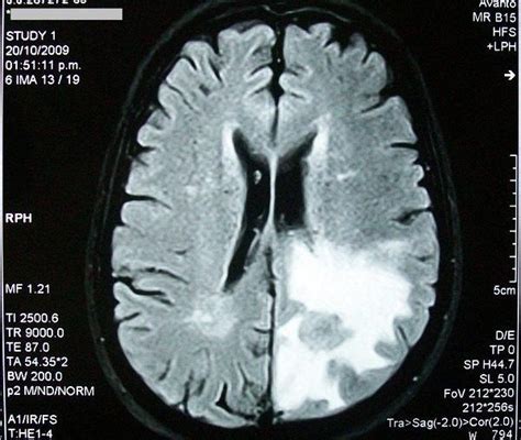 Qu Es Un Edema Tipos Causas S Ntomas Y Tratamiento Demedicina