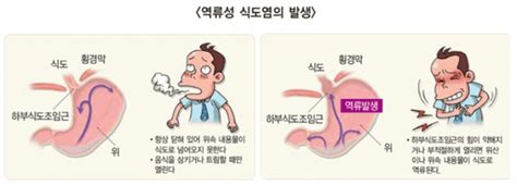 역류성 식도염 증상 및 원인 치료 약 역류성 식도염에 좋은 음식