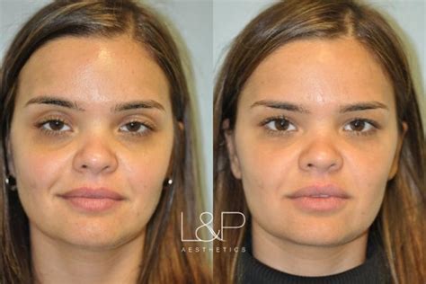 Facial Fillers Before And After Photos Case Palo Alto San Jose