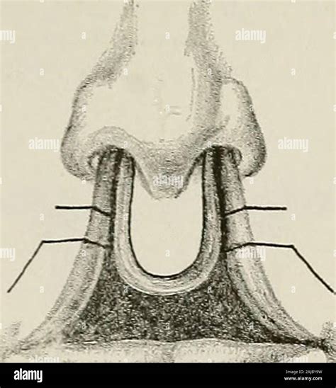 Double Harelip Hi Res Stock Photography And Images Alamy