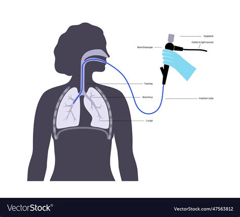 Bronchoscopy procedure concept Royalty Free Vector Image