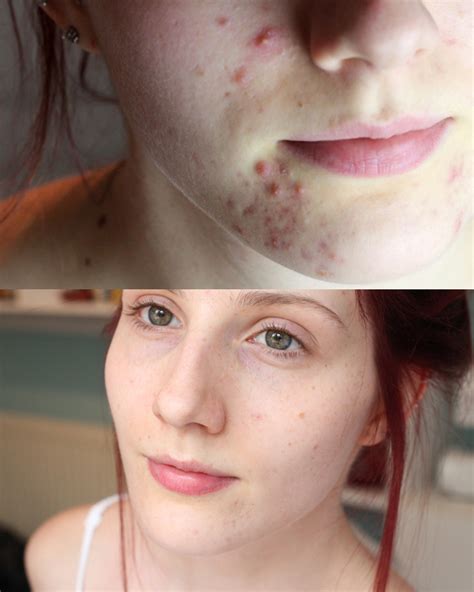 8 Incredible Acne Transformations: Before & After Pictures - The Korean ...