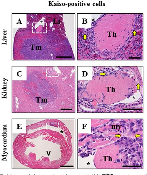 Figure 1 From Loss Of Kaiso Expression In Breast Cancer Cells Prevents