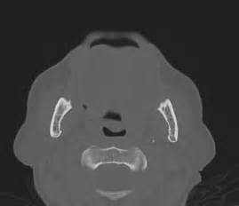 Chronic Mandibular Osteomyelitis With Large Sequestrum Image