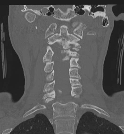 C Spine Injuries Ct Interpretation Core Em