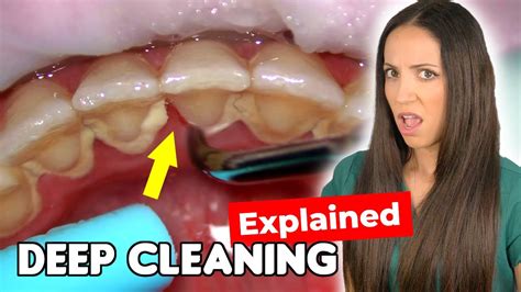 Dental Hygienist Explains Deep Cleaning Procedure YouTube