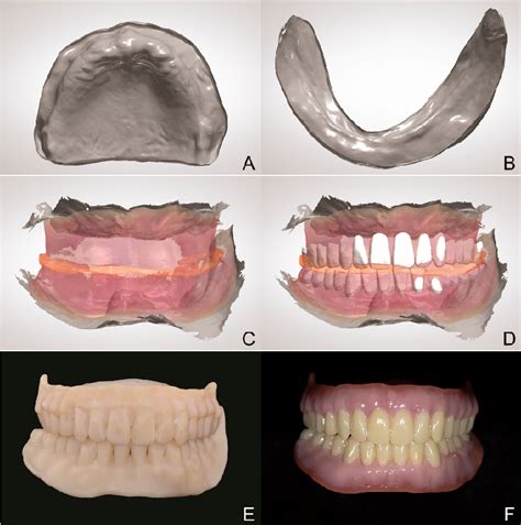 Pdf Digital Workflow To Fabricate Complete Dentures For Edentulous