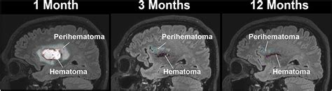 Frontiers Longitudinal Quantitative Multimodal Mri Evaluation Of