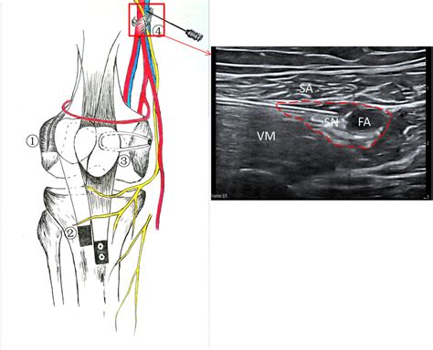 3in1 Procedure Surgery With Recurrent Patellar Dislocation And