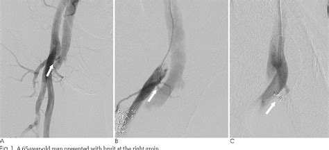 Figure From Iatrogenic Femoral Arteriovenous Fistulas Endovascular