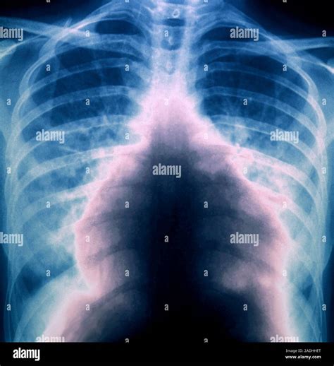 L Embolie Pulmonaire Frontal Couleur X Ray De La Poitrine D Un Patient