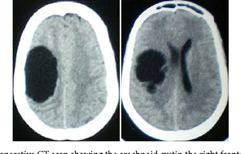 Figure 1 From Giant Intracranial Arachnoid Cyst Causing Acute Neurologic Symptoms Semantic Scholar